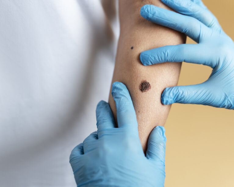 Wart Removal in Qatar – Safe, Fast & Effective Treatment at American Hospital Doha