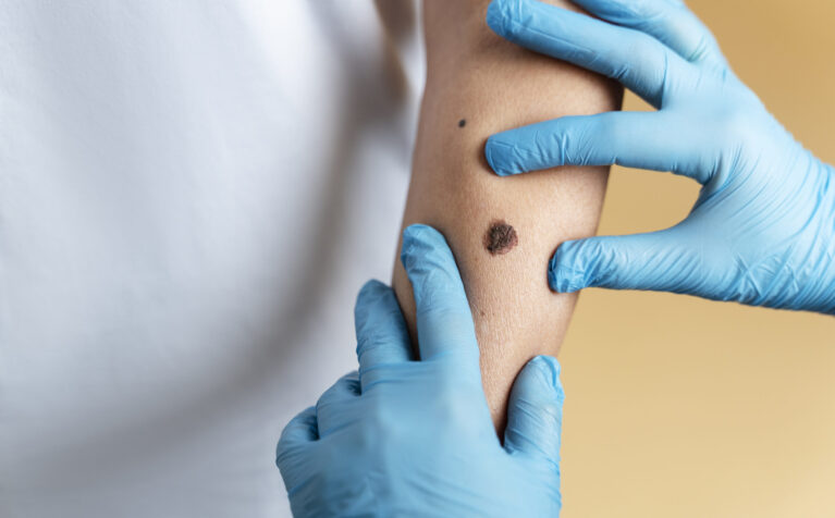 Wart Removal in Qatar – Safe, Fast & Effective Treatment at American Hospital Doha