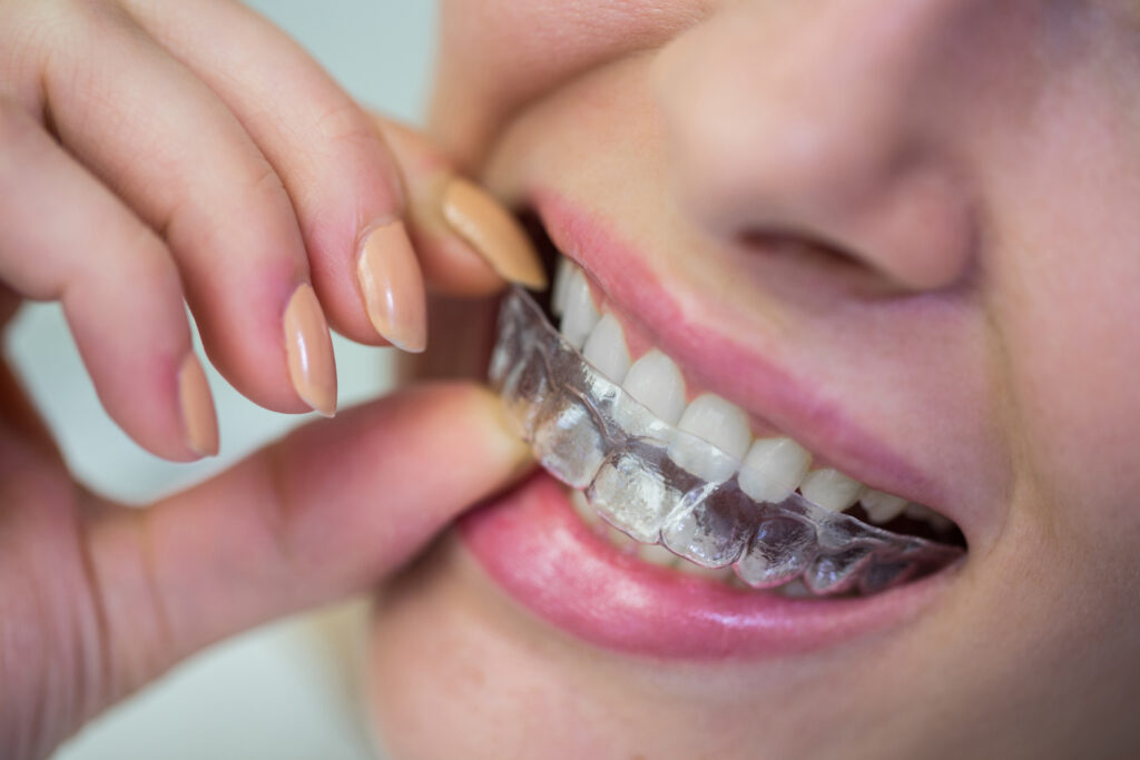 A dentist wearing blue gloves holding a set of orthodontic brackets and a clear aligner in a dental clinic