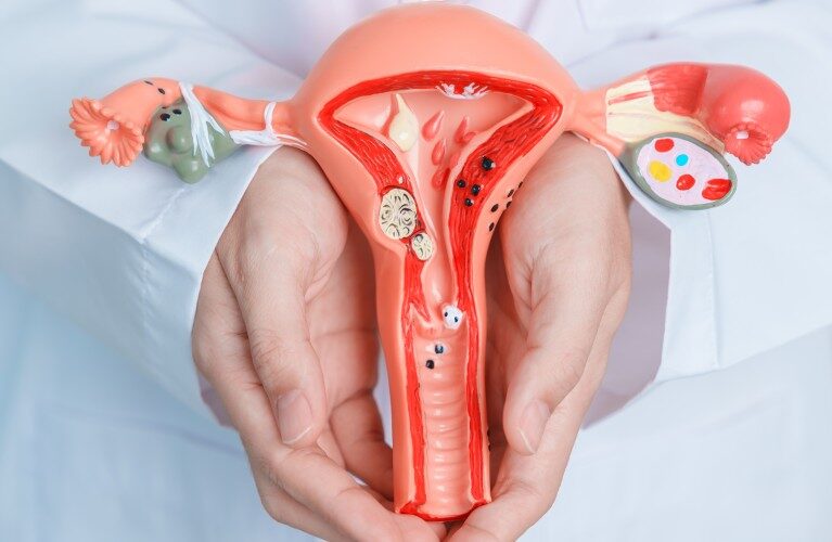 How Is PCOS Diagnosed and Treated? – Complete Women’s Health Guide in Qatar