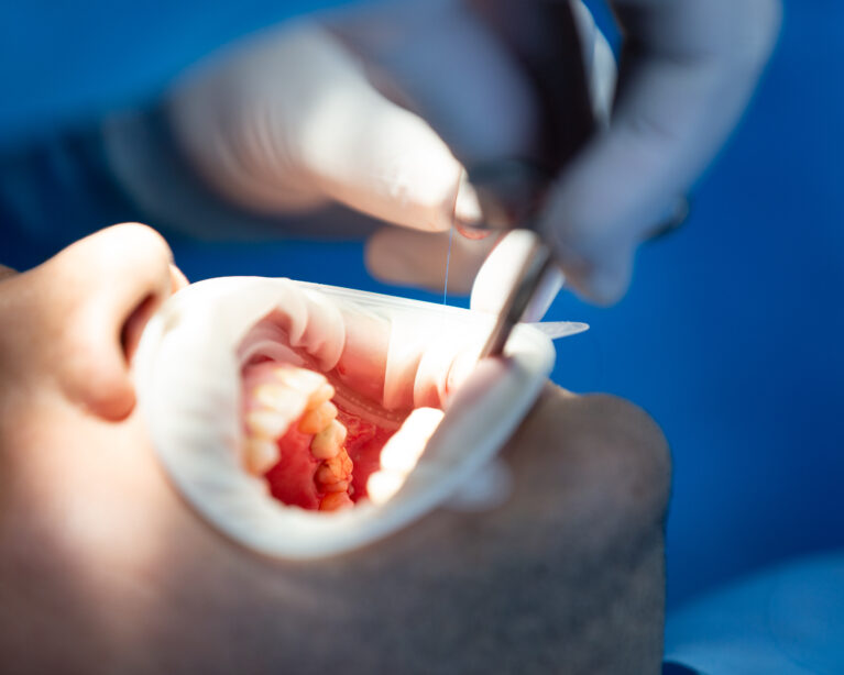 oral cancer symptoms Qatar