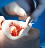 oral cancer symptoms Qatar