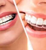 Clear Aligners vs Traditional Braces