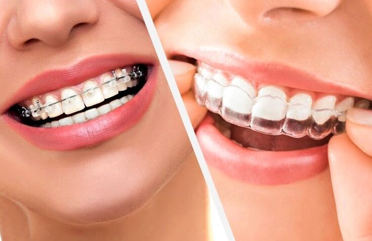 Clear Aligners vs Traditional Braces