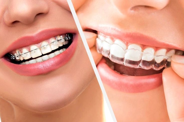 Clear Aligners vs Traditional Braces