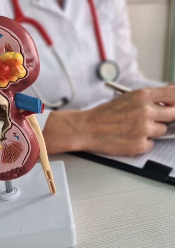 Kidney Stones