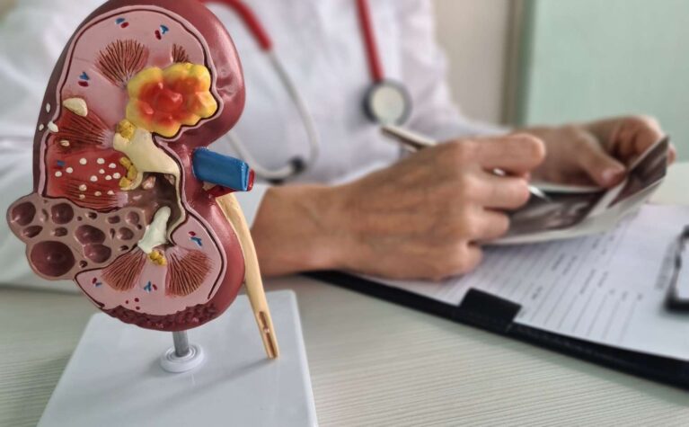 Kidney Stones