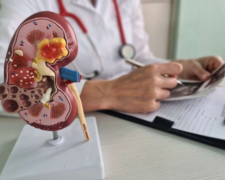 Kidney Stones