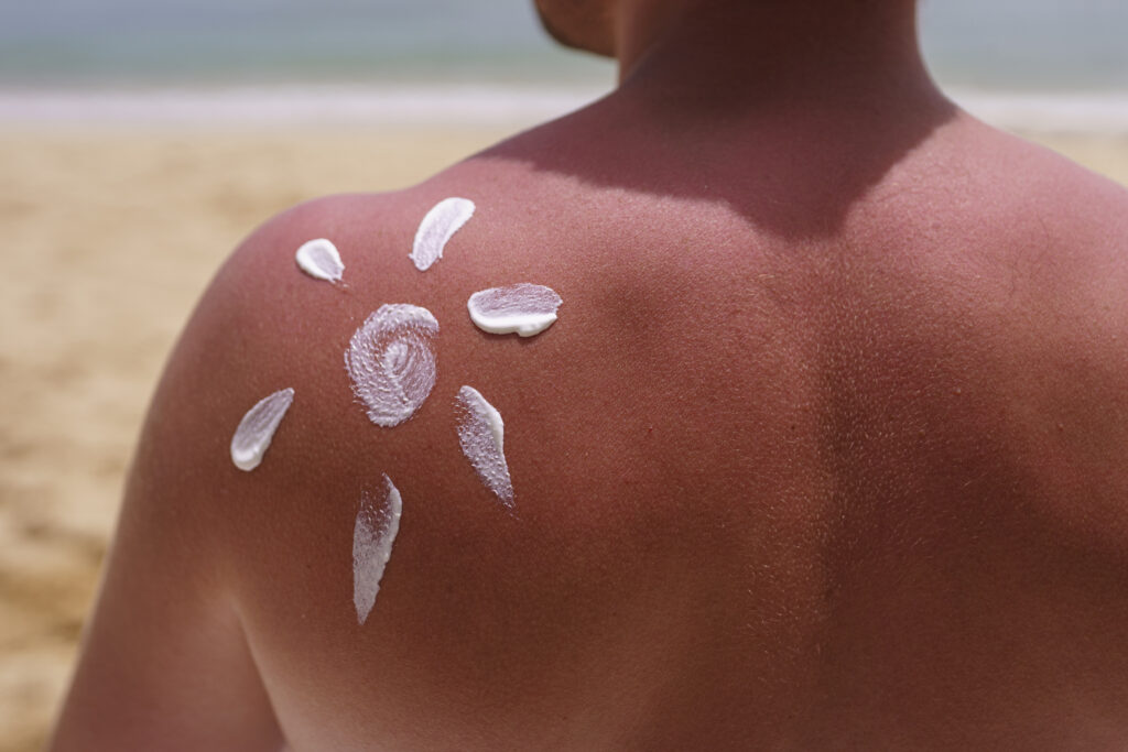 Person protecting sunburned skin from further sun exposure.