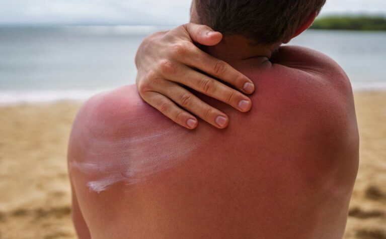 Sunburned skin receiving soothing care and protection.