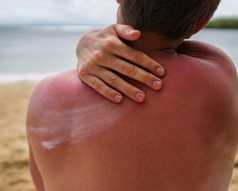 Sunburned skin receiving soothing care and protection.