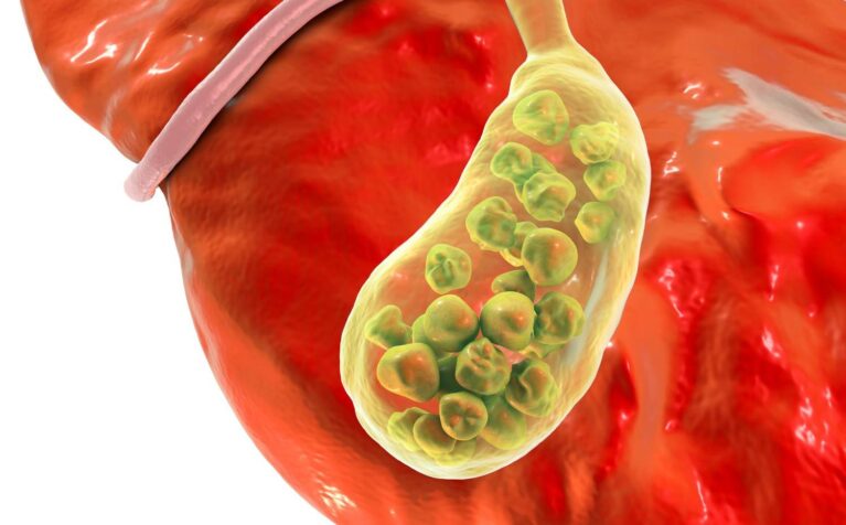 Medical consultation for gallbladder stone treatment and surgery