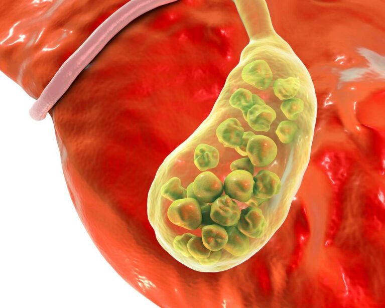 Medical consultation for gallbladder stone treatment and surgery
