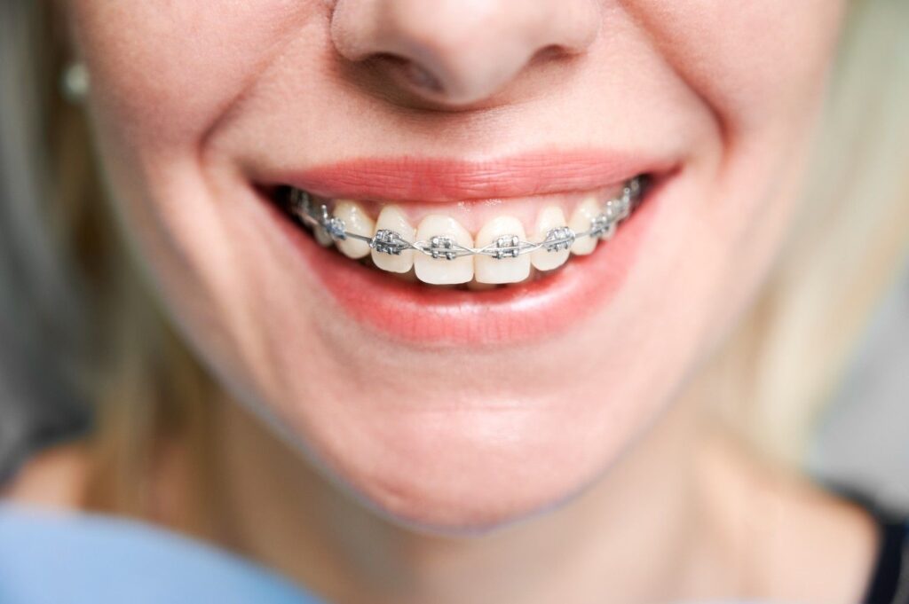 Lingual braces attached to the back of the teeth