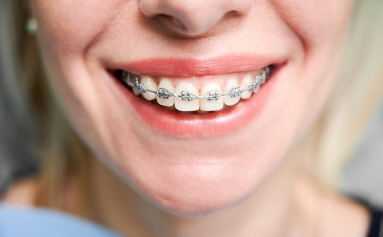 Lingual braces attached to the back of the teeth